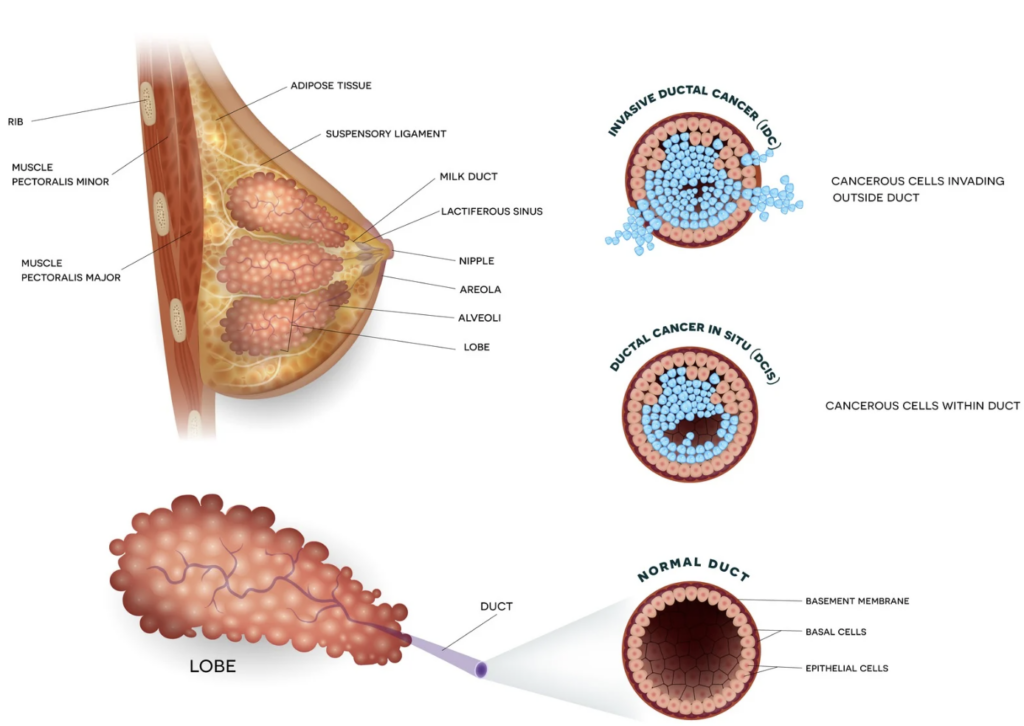 Ductal carcinoma 