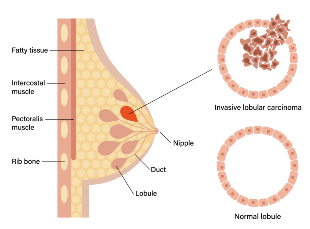 Lobular carcinoma