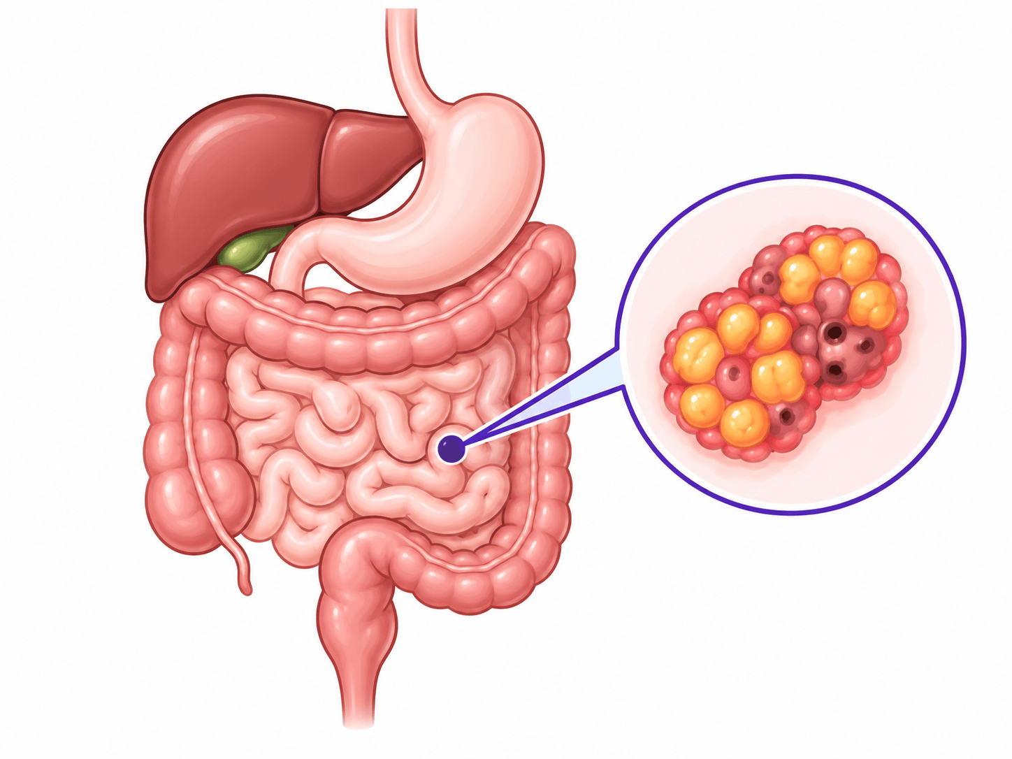 Illustration of the treatment target for Lutathera